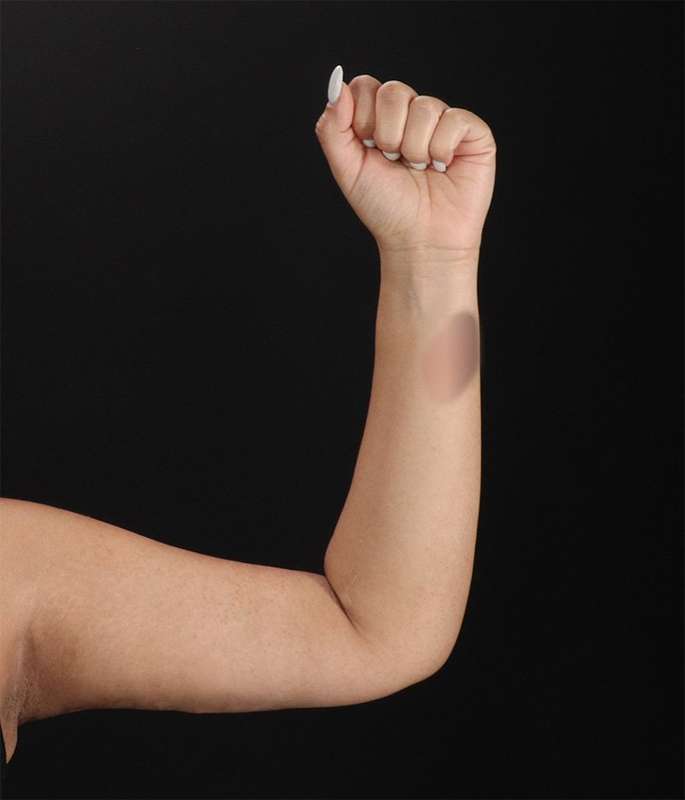 Brachioplasty (Arm Lift) Before & After Patient #1150