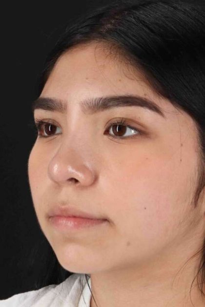 Rhinoplasty Before & After Patient #5848