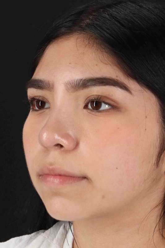Rhinoplasty Before & After Patient #5848