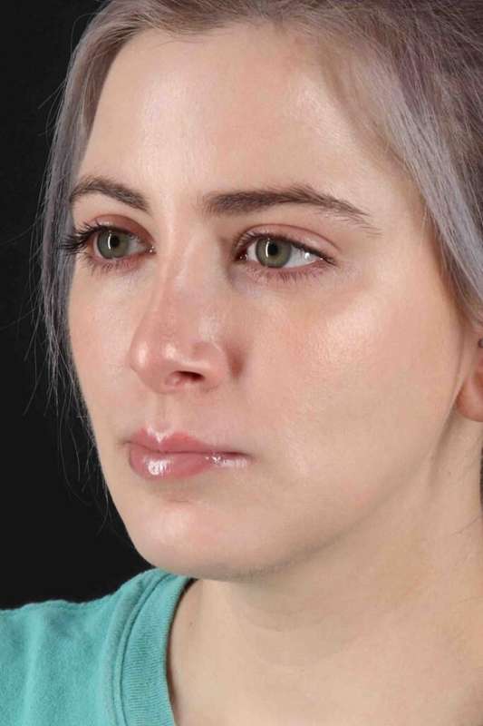 Rhinoplasty Before & After Patient #5859
