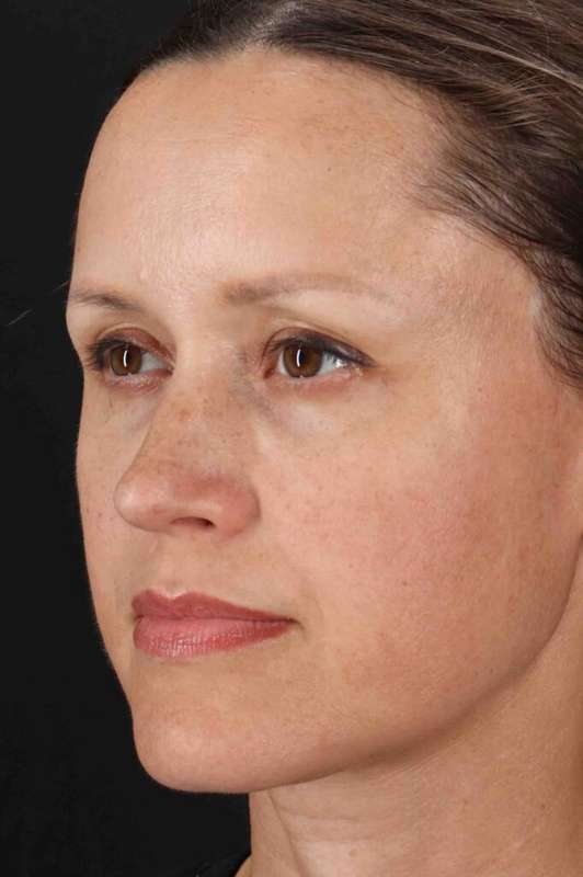 Rhinoplasty Before & After Patient #5870