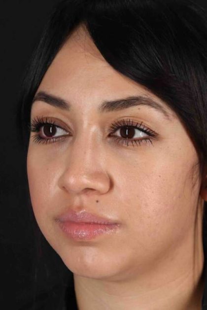 Rhinoplasty Before & After Patient #5881