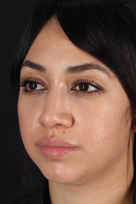 Rhinoplasty Before & After Patient #5881