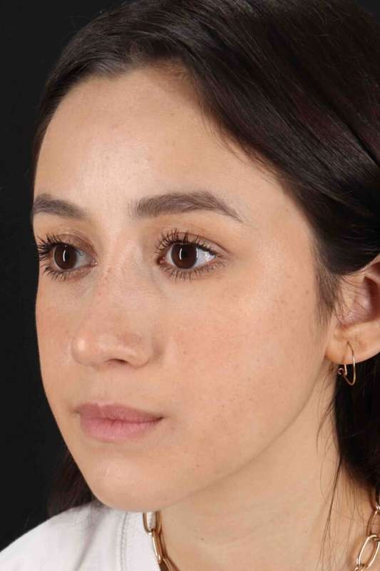 Rhinoplasty Before & After Patient #5892
