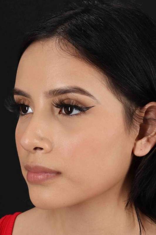 Rhinoplasty Before & After Patient #5903