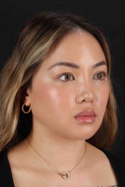 Rhinoplasty Before & After Patient #5914