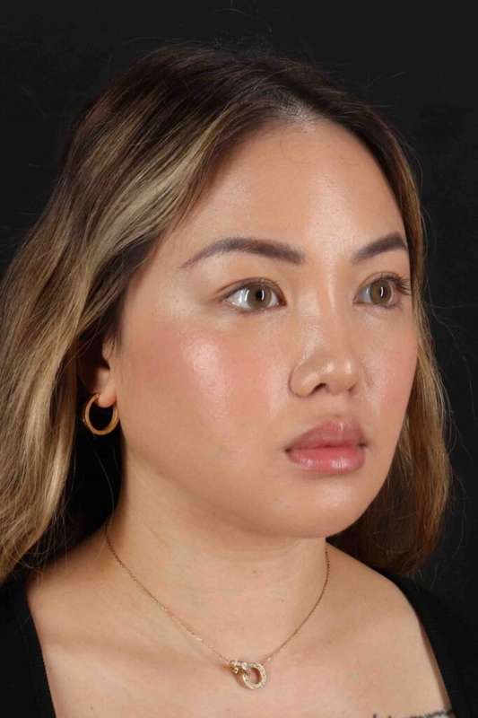 Rhinoplasty Before & After Patient #5914