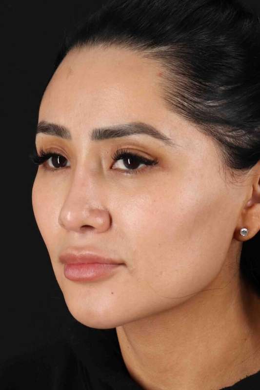 Rhinoplasty Before & After Patient #5925