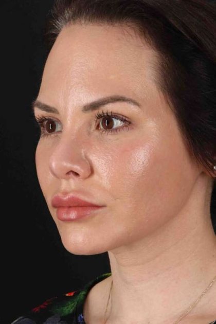 Rhinoplasty Before & After Patient #5936