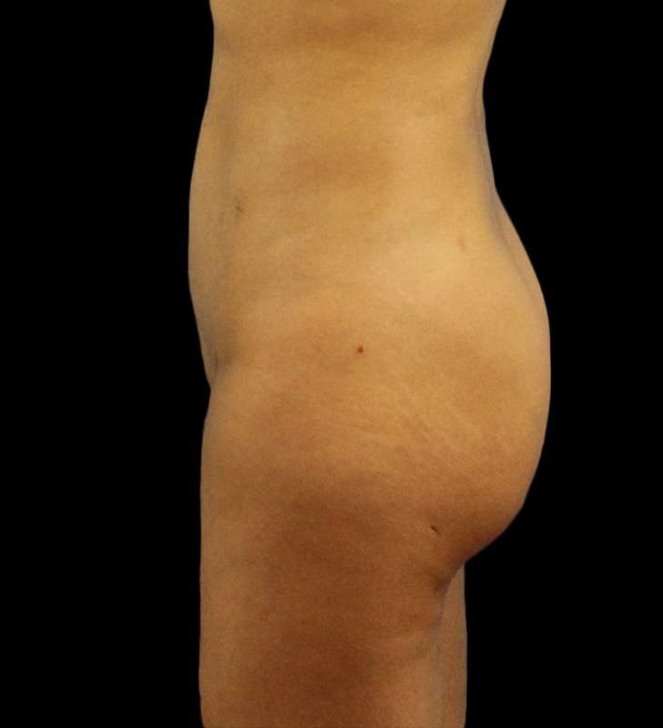 Cosmetic Body Lift Before & After Patient #1186