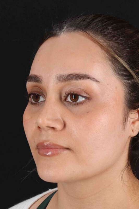 Rhinoplasty Before & After Patient #5947
