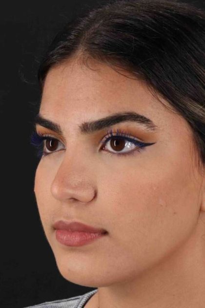 Rhinoplasty Before & After Patient #5958