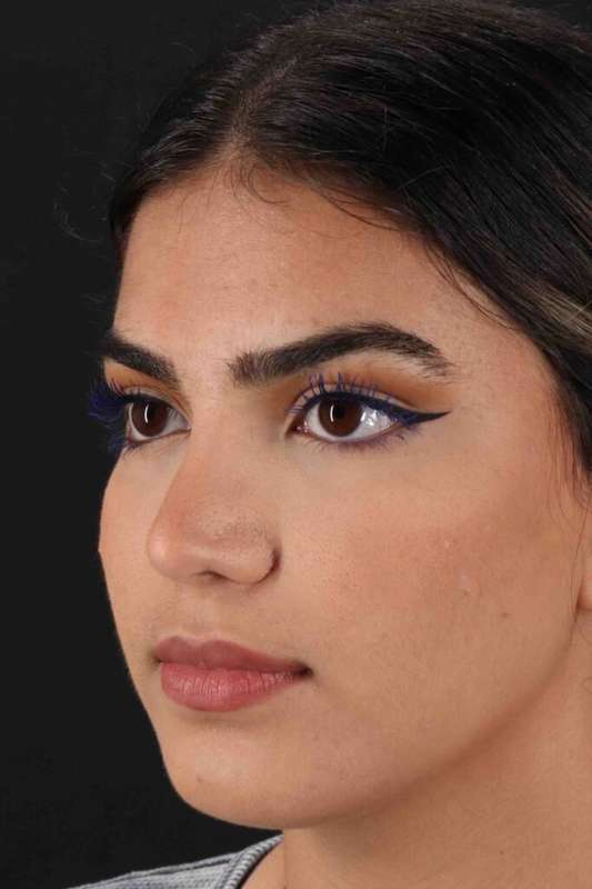 Rhinoplasty Before & After Patient #5958