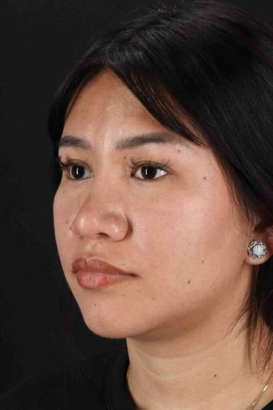 Rhinoplasty Before & After Patient #5983