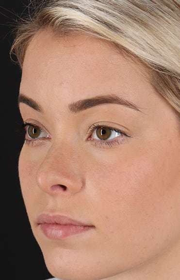 Rhinoplasty Before & After Patient #6178