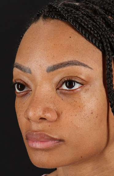 Rhinoplasty Before & After Patient #6189