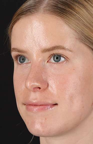Rhinoplasty Before & After Patient #6200