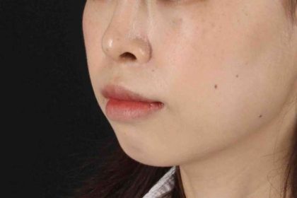Lip Reduction Before & After Patient #6222