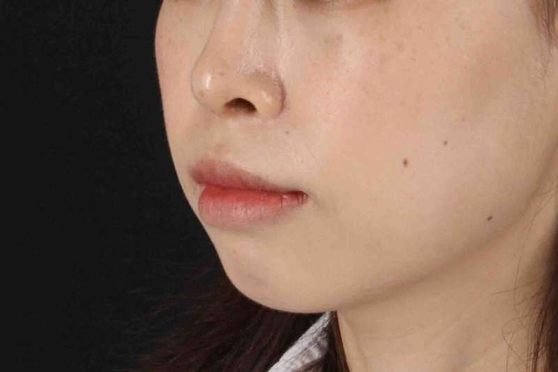 Lip Reduction Before & After Patient #6222