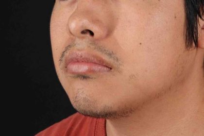 Lip Reduction Before & After Patient #6233