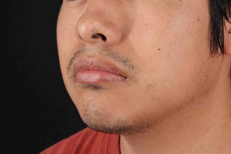 Lip Reduction Before & After Patient #6233