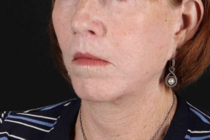 Lip Lift Before & After Patient #6255