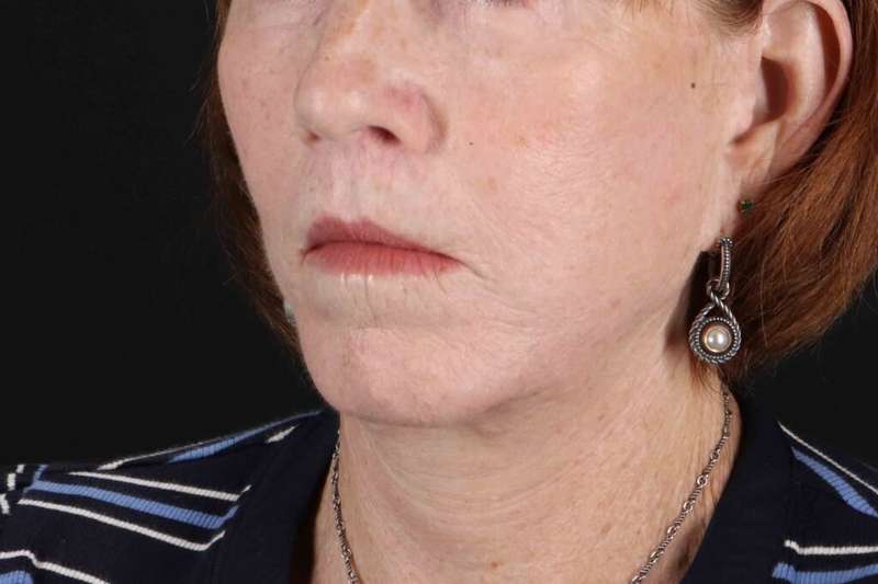 Lip Lift Before & After Patient #6255