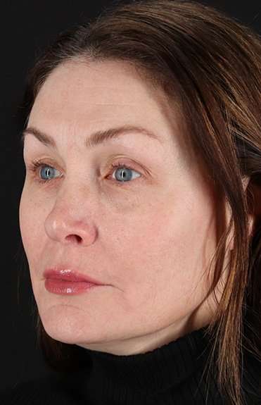 Lip Lift Before & After Patient #6266