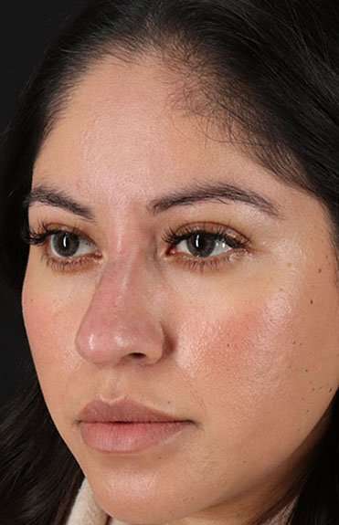 Liquid Rhinoplasty Before & After Patient #6319