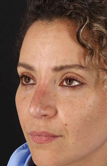 Liquid Rhinoplasty Before & After Patient #6333