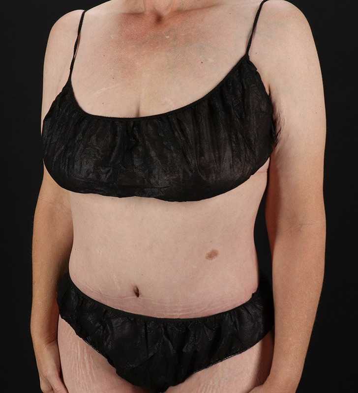 Cosmetic Body Lift Before & After Patient #1218