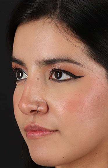 Liquid Rhinoplasty Before & After Patient #6344