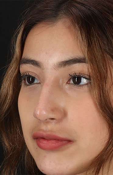 Liquid Rhinoplasty Before & After Patient #6355