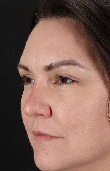 Liquid Rhinoplasty Before & After Patient #6366