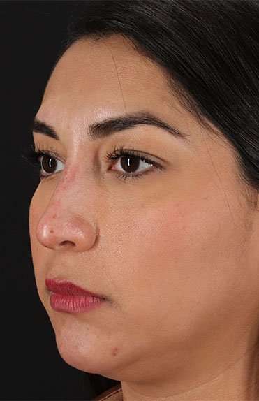 Liquid Rhinoplasty Before & After Patient #6377