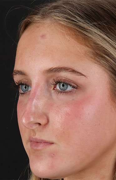 Liquid Rhinoplasty Before & After Patient #6388
