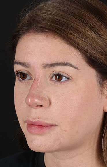 Liquid Rhinoplasty Before & After Patient #6399