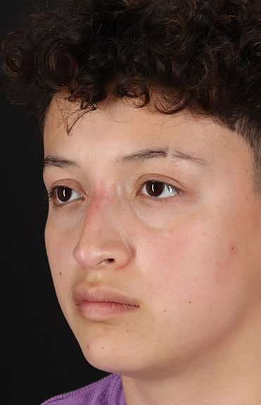 Liquid Rhinoplasty Before & After Patient #6410