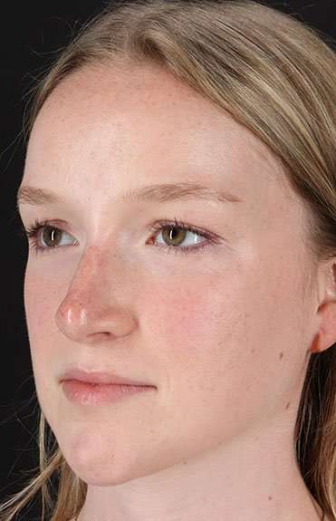 Liquid Rhinoplasty Before & After Patient #6425
