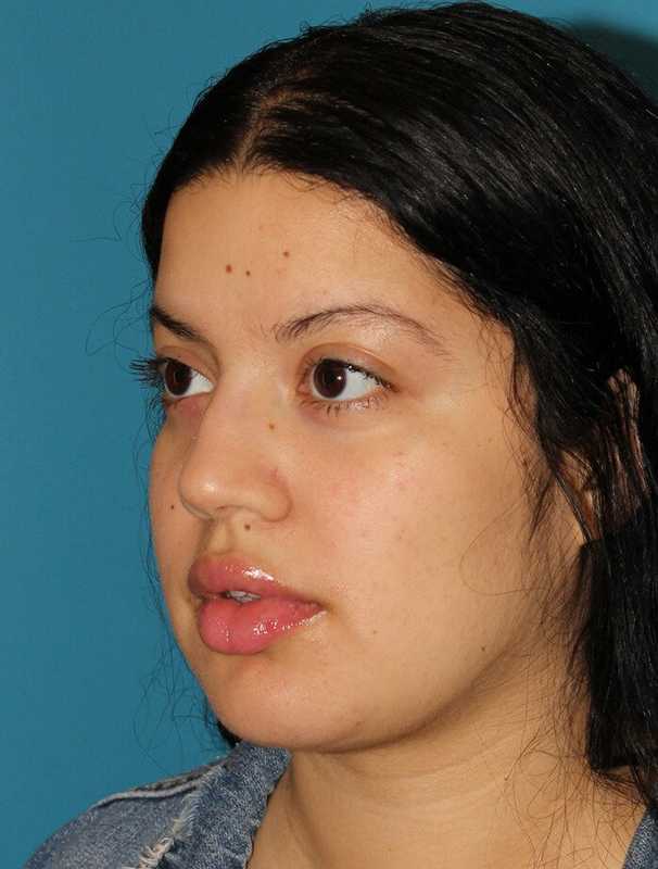 Buccal Fat Pad Before & After Patient #6436