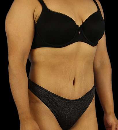 Abdominoplasty (Tummy Tuck) Before & After Patient #601