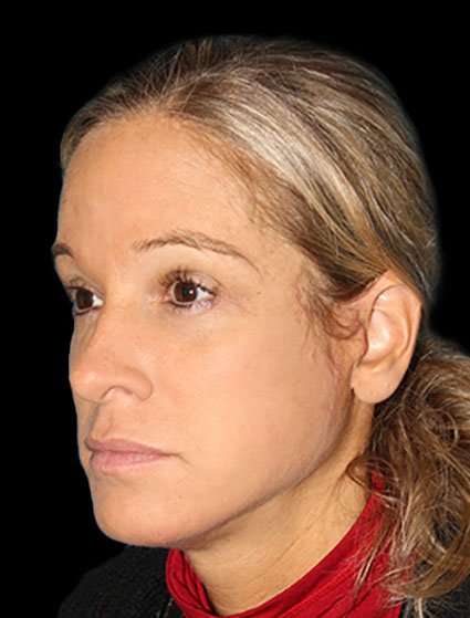 Neck Lift Before & After Patient #6517