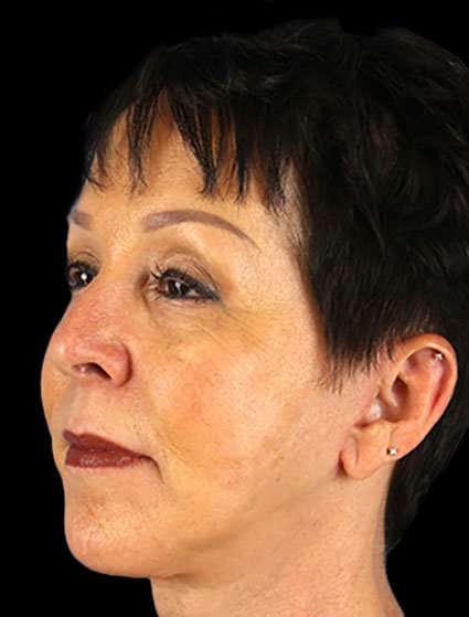 Neck Lift Before & After Patient #6528