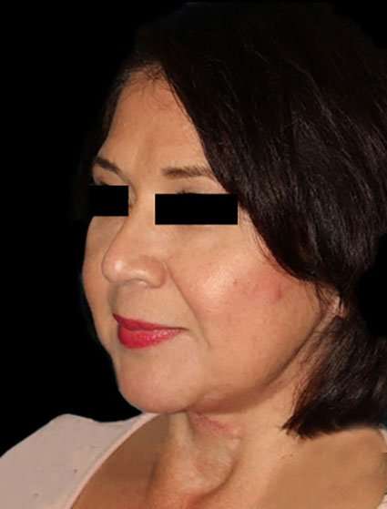 Neck Lift Before & After Patient #6539