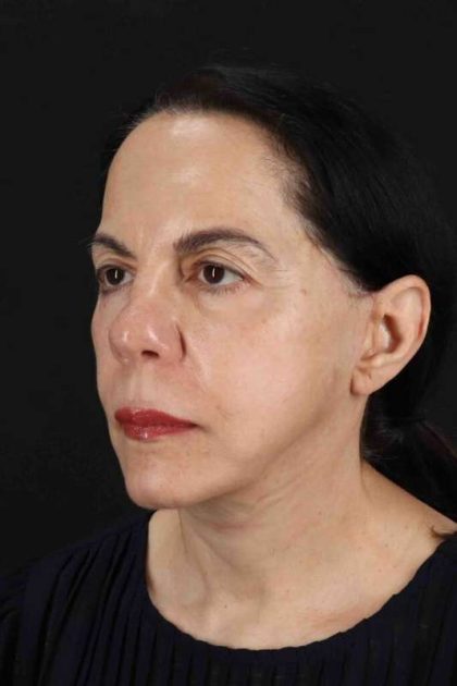 Neck Lift Before & After Patient #6642