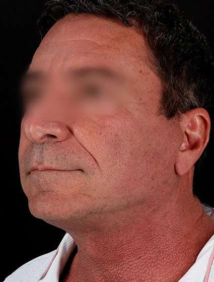 Neck Lift Before & After Patient #6698