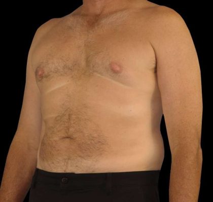 Liposuction Before & After Patient #1270