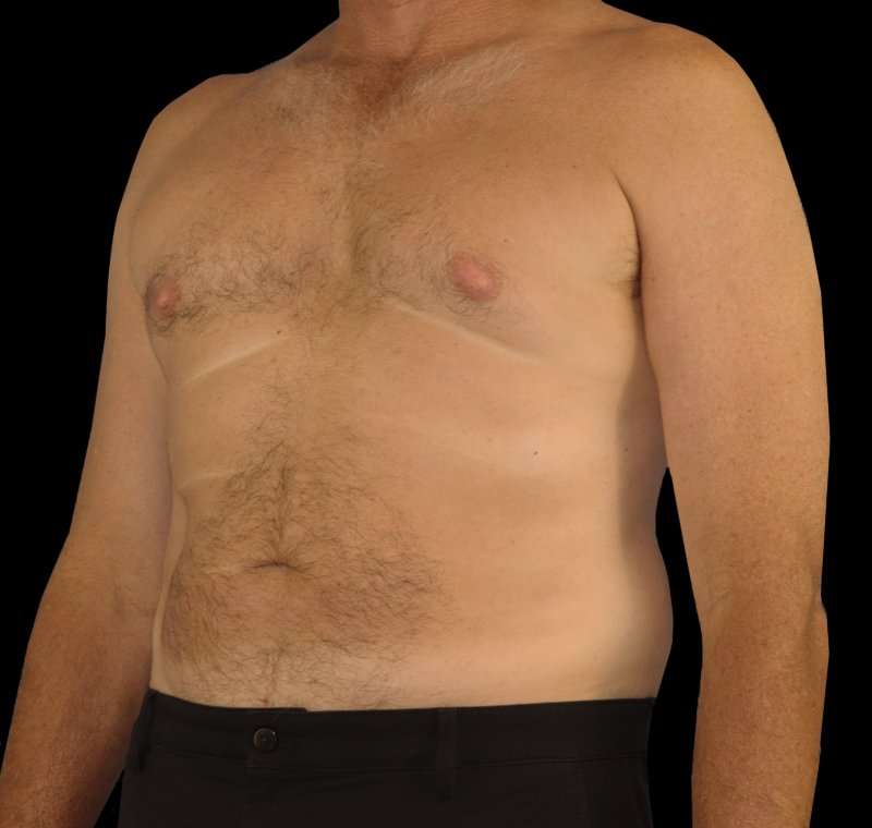 Liposuction Before & After Patient #1270