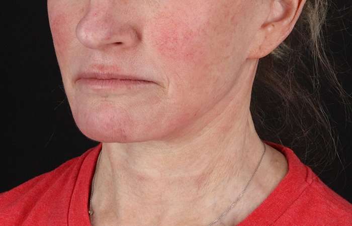 Neck Lift Before & After Patient #6731