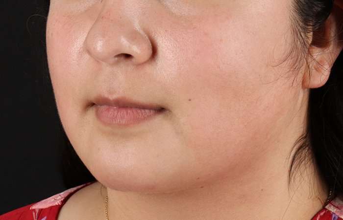 Neck Lift Before & After Patient #6743